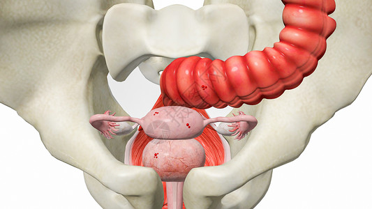 右侧肛提肌腱弓子宫内膜异位症设计图片