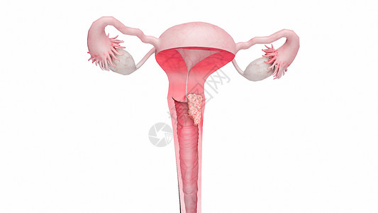 子宫颈癌二期背景图片