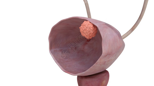 红色皮膀胱癌2期肿瘤设计图片
