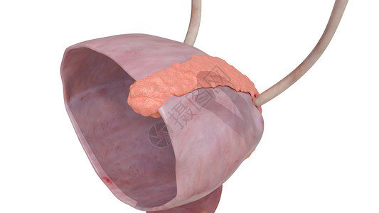 膀胱癌3期肿瘤设计图片