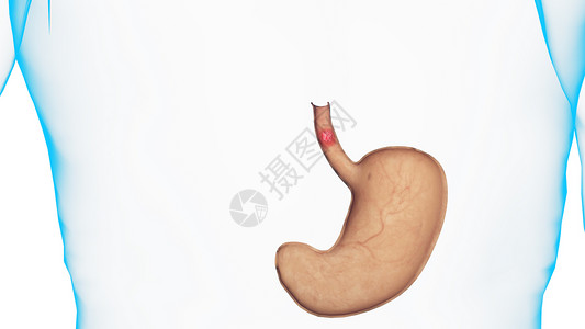 食管鳞状细胞癌图片