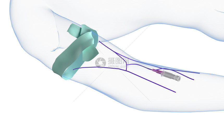 静脉注射插管插入图片