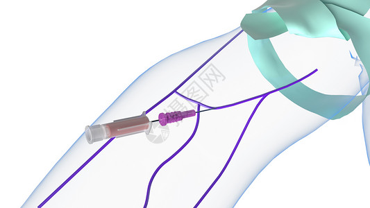 静脉注射第二次闪回高清图片