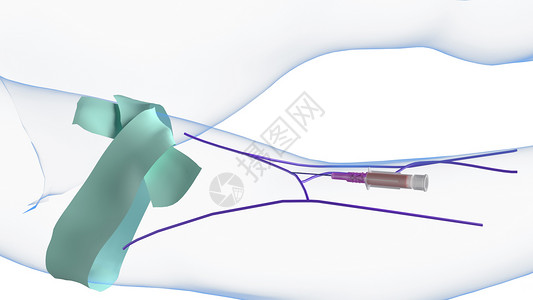 医疗导管静脉注射第一次闪回设计图片