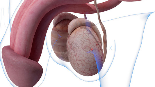 睾丸癌第0阶段图片