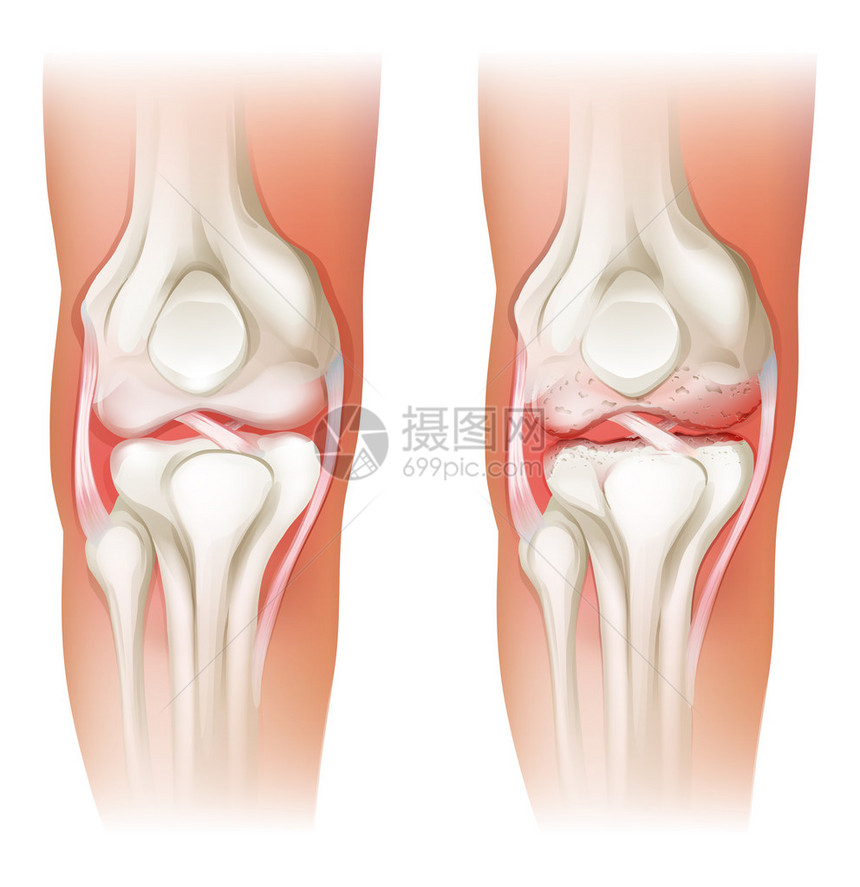 白色背景下人类膝关节炎的插图图片