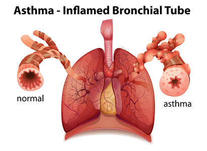 粒细胞在白色背景上显示哮喘发炎支气管的图像设计图片