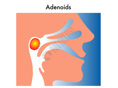 腺样体的简单医学插图插画
