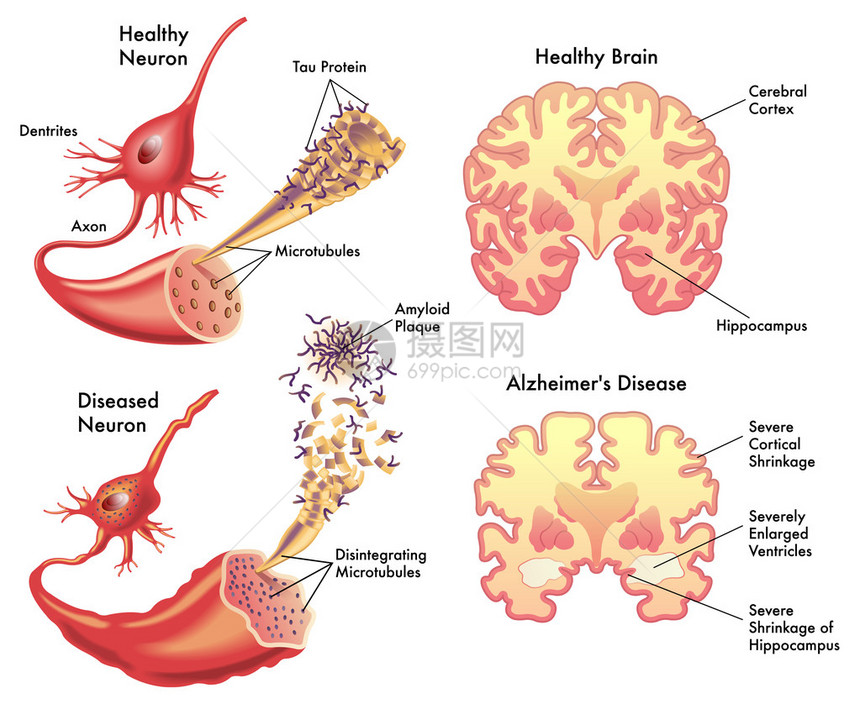 阿尔茨海默病图片