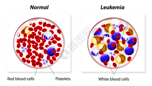 白血病是身体造血组织中的一种癌症图片