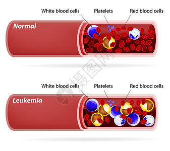癌症有红细胞和白细胞的血管图片