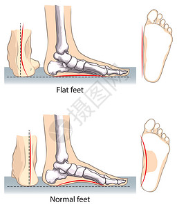 扁平和正常的脚高清图片