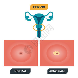 人类子宫颈结构说明正背景图片