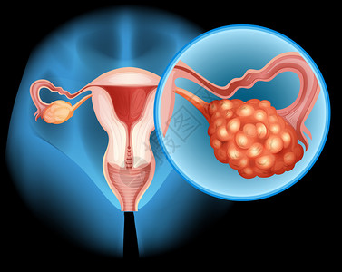 卵巢癌详述的Ovar插画