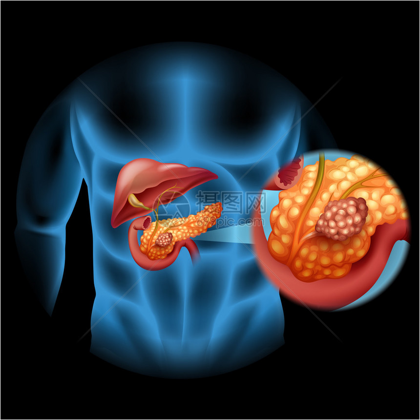 人体图解中的胰腺癌图图片