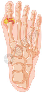 显示痛风脚趾插图的表图片