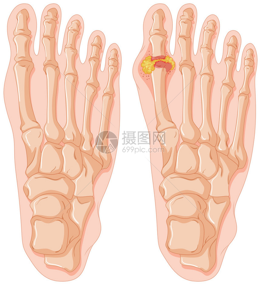 人脚趾痛风图解图片