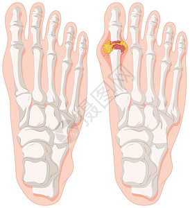 人脚插图中的痛风脚趾图片