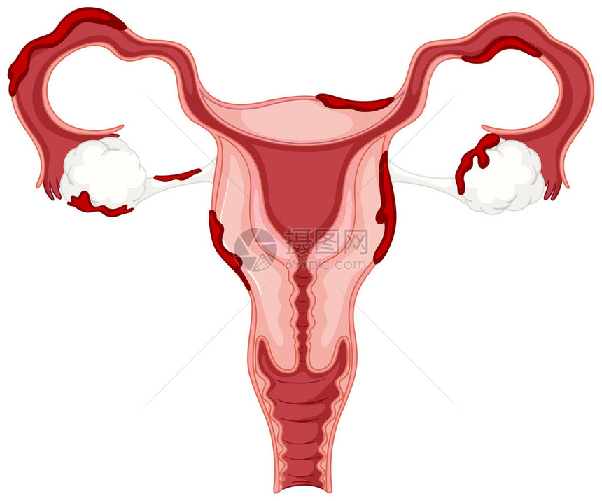 子宫内膜异位症女卵巢图图片