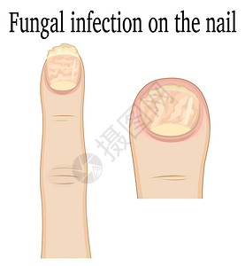脚和手的指真菌感染图片