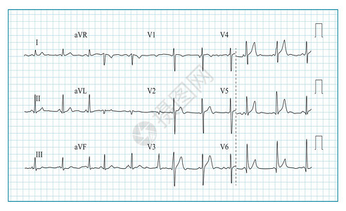 心脏电图表向量检查心电图上波形的插图心律背景图片