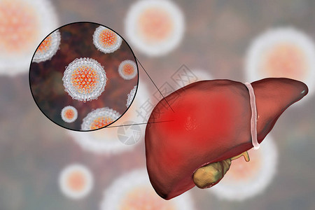 丙型肝炎感染的肝脏和丙型肝炎HCV的特写视图图片