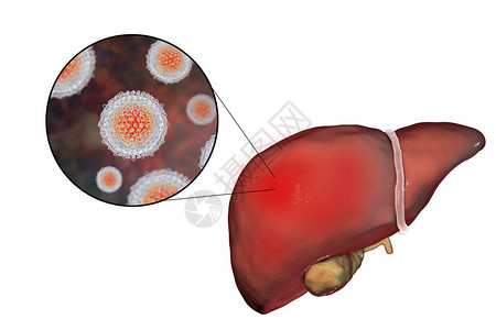 肝硬化阶段丙型肝炎感染的肝脏和丙型肝炎HCV3D插背景图片