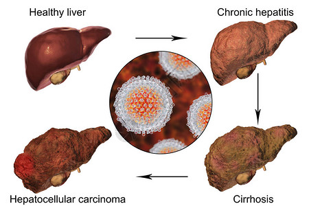 肝炎C感染的肝病例增图片