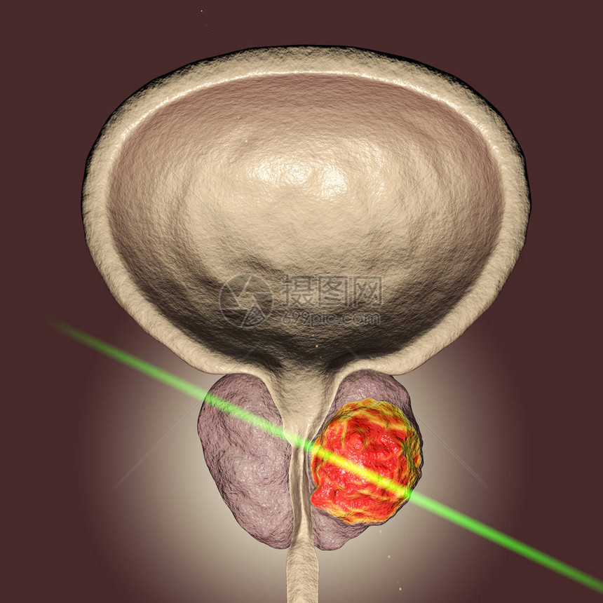 前列腺癌激光治疗概念图图片