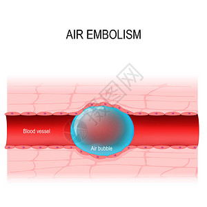 空气栓塞气体栓塞是血管阻塞图片