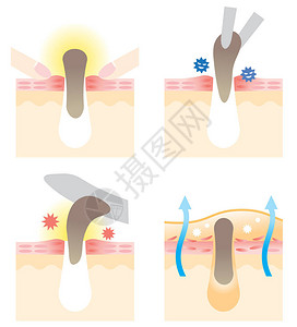 翻录4种方法来解缩孔挤压用树枝抽取撕掉插画