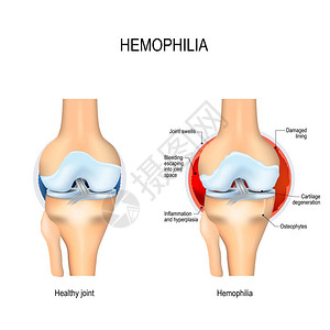 健康的膝盖和与Heemophoph图片