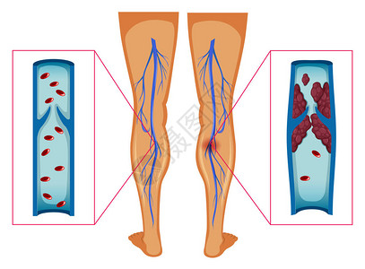 图表显示人腿插图中的血块图片