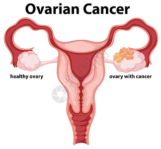 宫颈息肉女卵巢癌概念绘图插设计图片