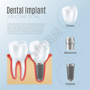 牙科修复信息图表海报的结构图片