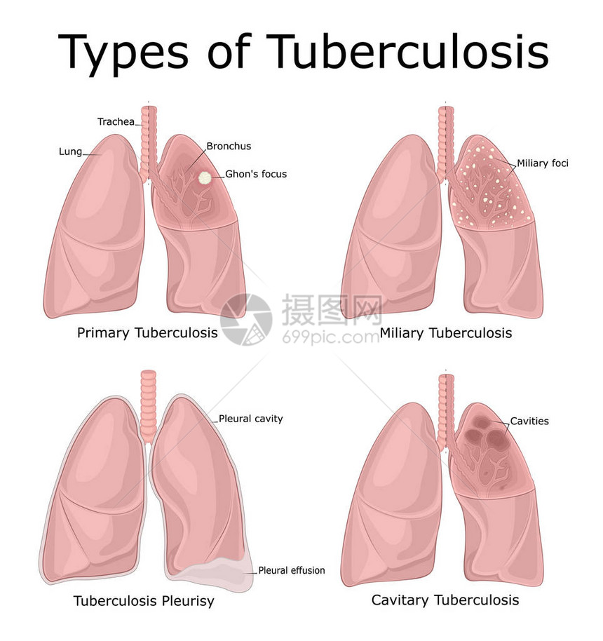 不同类型结核病初级军事蓄图片