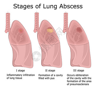 肺病三阶段肺图片