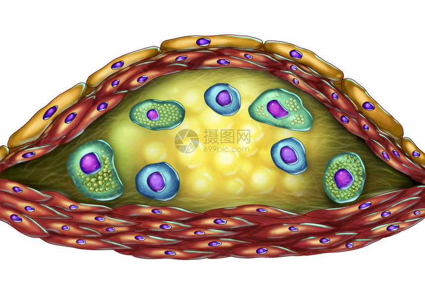 动脉粥样硬化斑块的结构插图显示坏死中心泡沫细胞胆固醇斑块内的T淋巴细胞图片