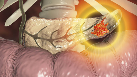胰腺炎胰腺癌胰腺恶肿瘤3D插图设计图片