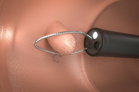 结肠息肉3d生成内窥镜用铁丝环设计图片