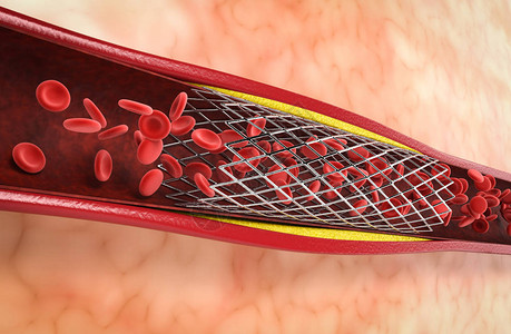 动脉硬化3d渲染球囊血管成形术与静脉支架设计图片