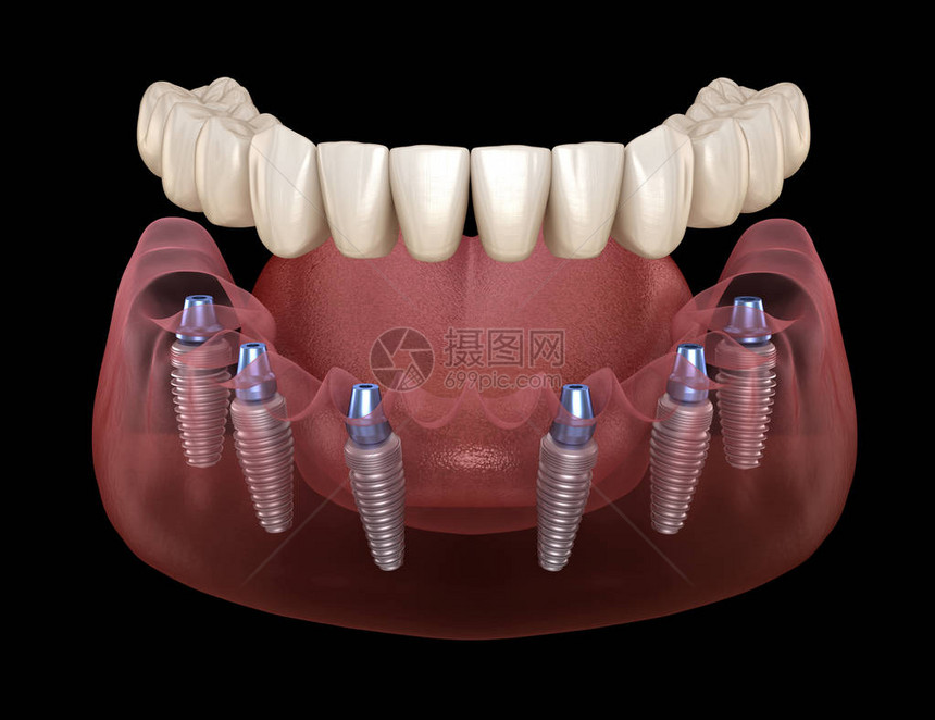 下颌假体Allon6系统由植入物支持人类牙齿和假牙概念的医学上准确的图片