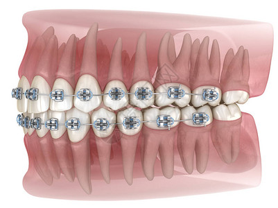 金属牙套和透明牙科模型医学上准图片