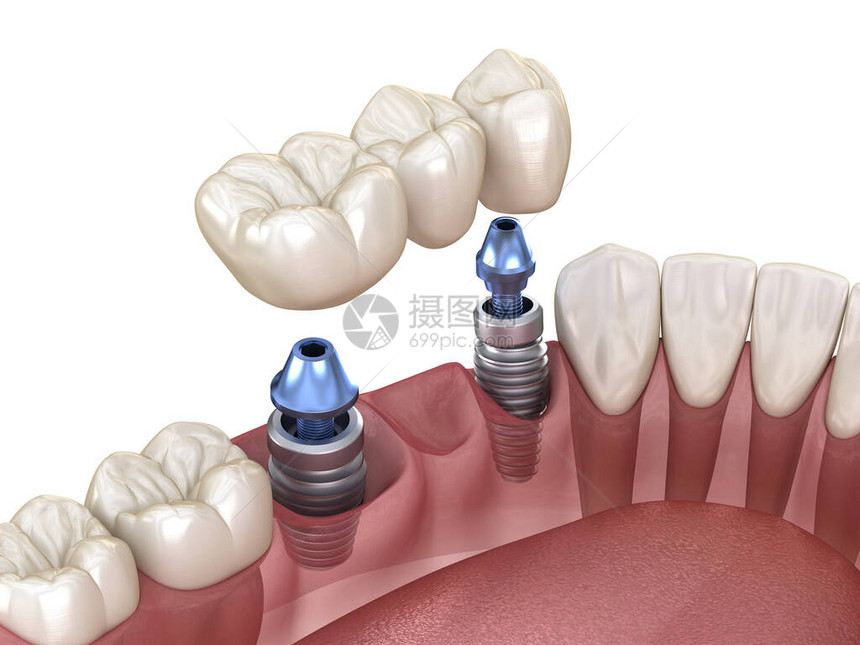 用植入器支持的牙科桥医学上准确的3D人类牙齿和图片