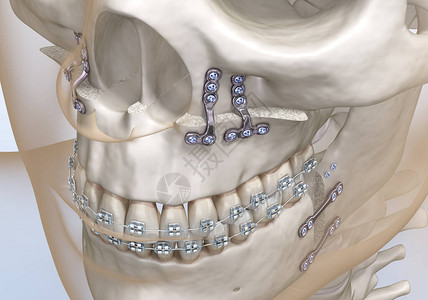 Maxillomandibular推进手术图片
