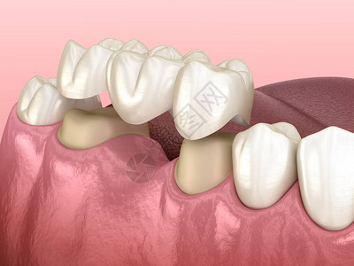 用于人体牙齿治疗的医学精确3D插图图片
