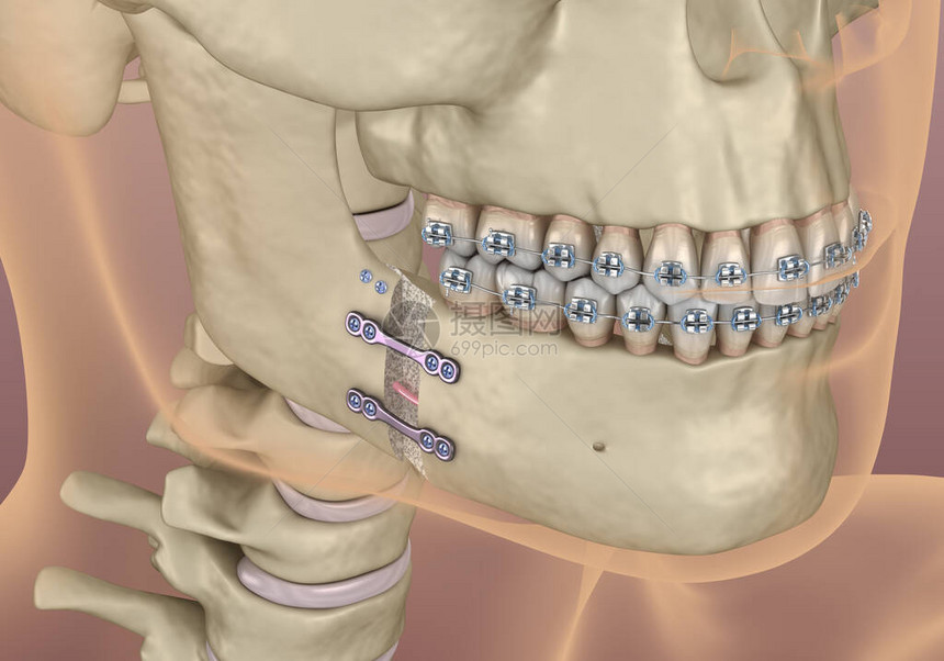人工推进手术医学上准确的牙科3D插图片