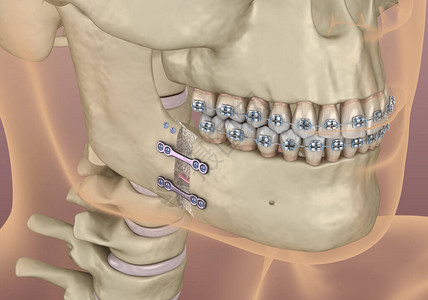 下颌人工推进手术医学上准确的牙科3D插设计图片
