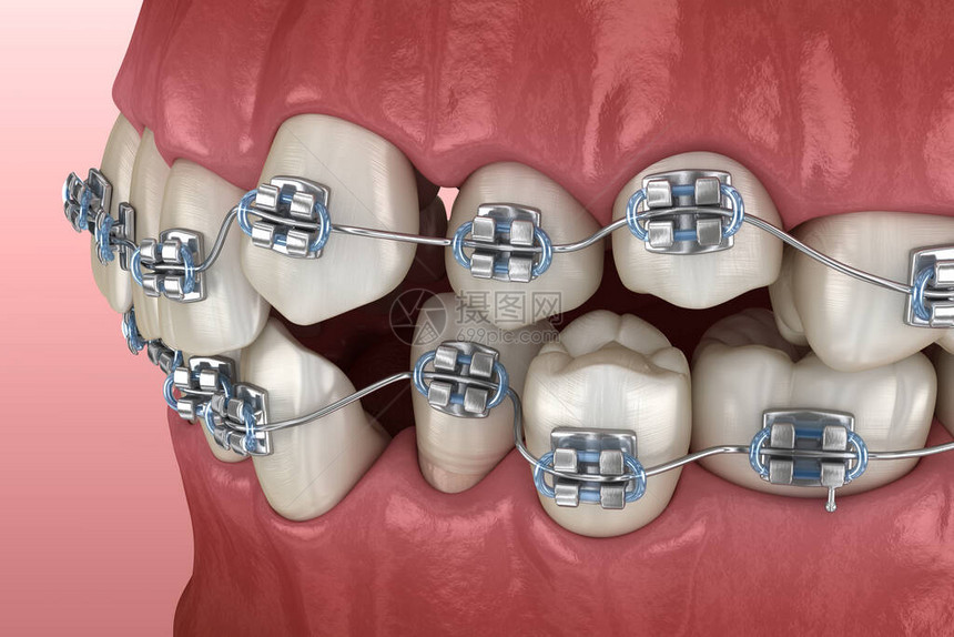 异常牙齿姿势和金属牙套对立医学上准确的图片
