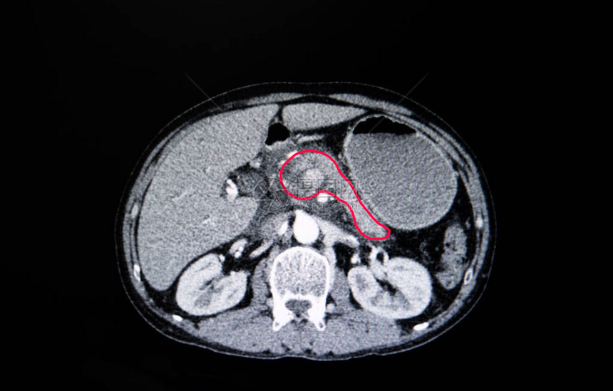 对一名患有胰腺癌的病人腹部进行CT扫描图片